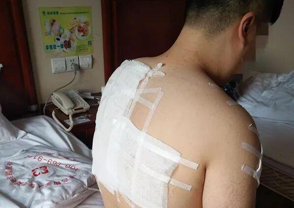 南京一酒店浴室玻璃爆炸，住客缝12针